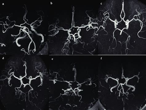 Image result for Type 1 Variation