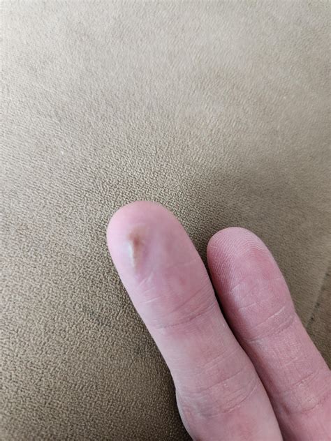 itchy fluid filled bump on finger, started as lump under skin, then ...