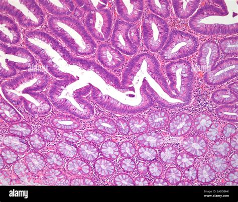 Polyps In Colon Tubular Adenoma at Daniel Isaac blog