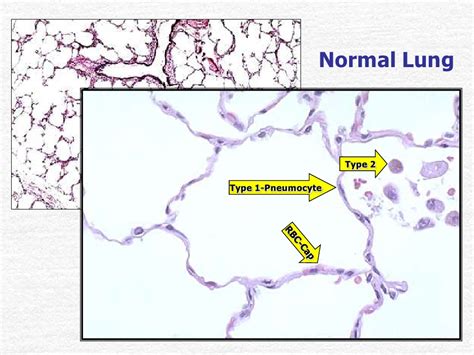 PPT - Pathology of Pneumonia PowerPoint Presentation, free download ...