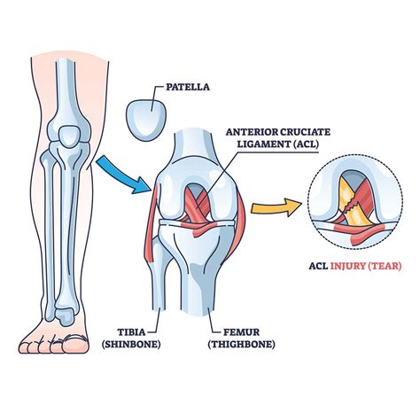 Acl Knee Injury