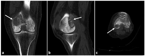 Malignant Knee Joint Effusion—A New Dimension of Laboratory Diagnostics