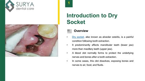 Dry Socket vs Normal Socket - Surya Dental Care | PPTX
