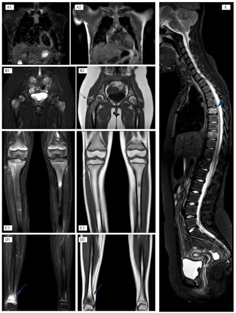 Chronic Non-Bacterial Osteomyelitis (CNO) in a Tertiary Center in ...