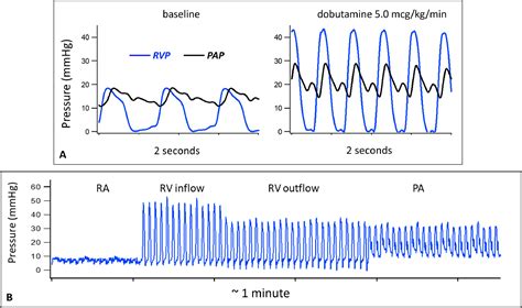 Right Ventricular Pressure Waveform Analysis—Clinical Relevance and ...
