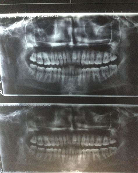 3 of my wisdom teeth have erupted well however the lower left one has only partially erupted and ...