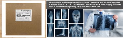 Dhawni Xray Inkjet Medical Film Blue Base for X Ray Imaging Waterproof ...