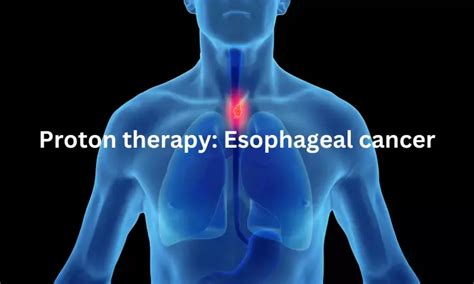 Proton therapy highly effective in esophageal cancer compared to proton ...