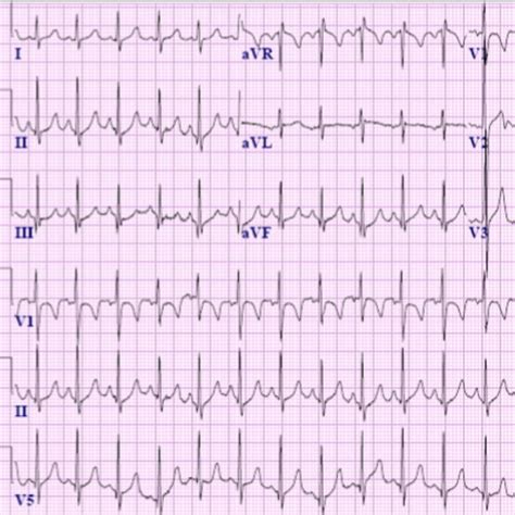 Image result for AFib Detection Algorithm