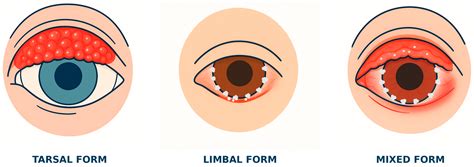 Ocular Manifestations in Children with Vernal Keratoconjunctivitis
