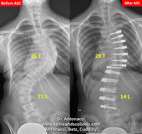 Before and After Scoliosis Surgery with Darryl Antonacci Institute for ...