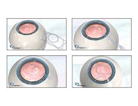 Best Lasik Laser Hospital in Chandigarh & India | Grover Eye Laser