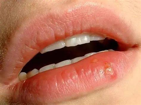 嘴巴上长这种泡千万要小心，可能会传染到生殖器！_嘴唇_病毒_患者