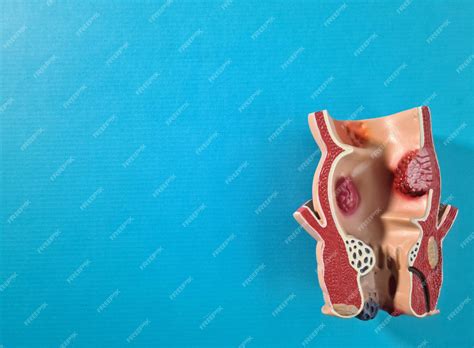 Anatomía del ano y tratamiento de enfermedades de las hemorroides del ...