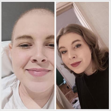 Chemotherapy Hair Loss Timeline