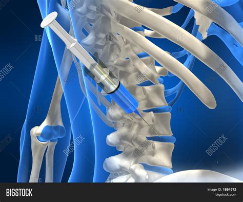 Image result for Disc Template Injection