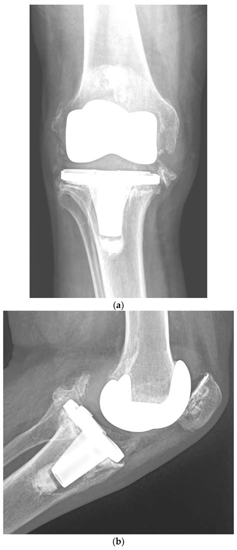 Risk Factors for Periprosthetic Joint Infection after Primary Total Knee Arthroplasty