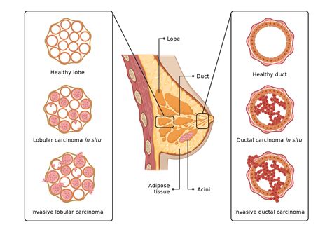 Graphical representation of the types of breast cancer | BioRender ...