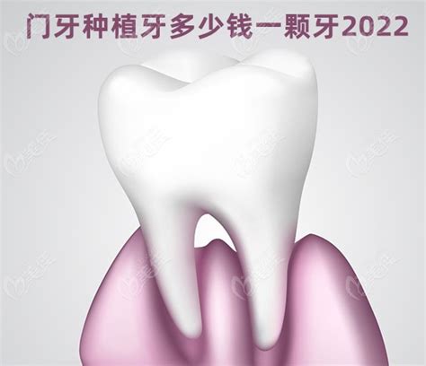 门牙种植牙多少钱一颗牙2022？各品牌种植牙、烤瓷牙、全瓷牙价格了解下 - 美佳社区