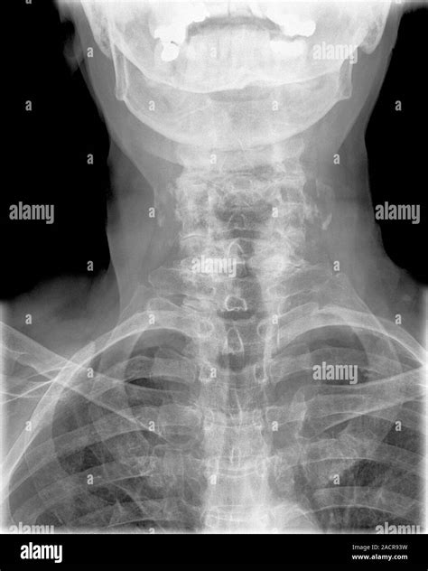 Arthritis of the neck. X-ray of the neck of a 67 year old female with ...