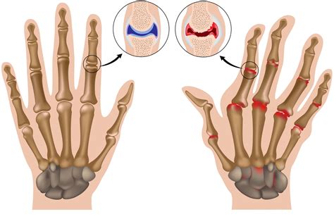 Hands – Arthritis « Oxford Orthopaedics