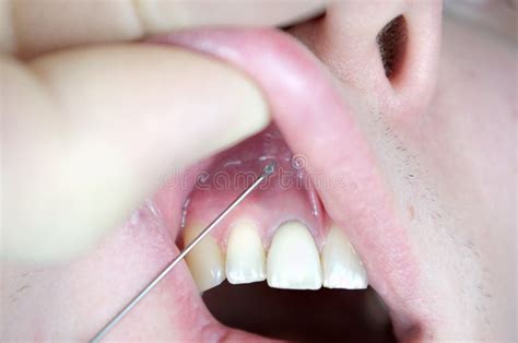 Infiltration Anesthesia 的图像结果