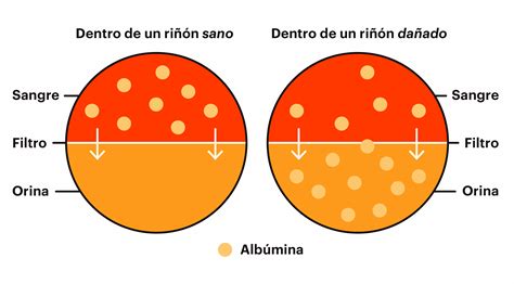 Albuminuria (proteinuria) | National Kidney Foundation