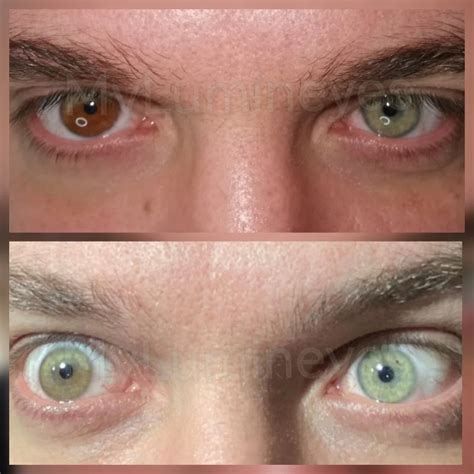 Image result for Eye Color Change Procedure