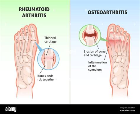 Foot disease poster. Medical orthopedic scheme, foot bones defects, joint with rheumatoid ...