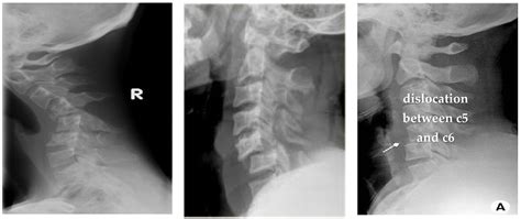 Dislocated Neck X Ray