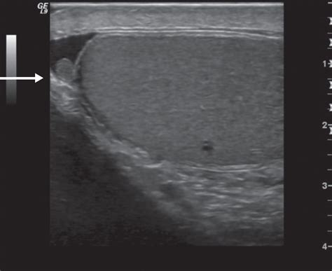 Scrotum - Clinical Tree