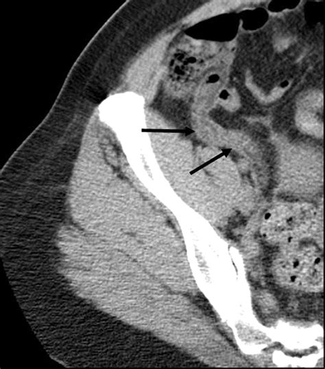 CT Evaluation of Appendicitis and Its Complications: Imaging Techniques and Key Diagnostic ...