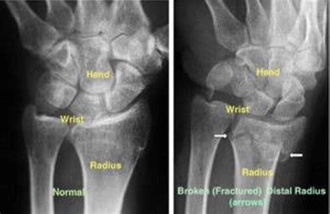 Image result for Simple Radius Fracture