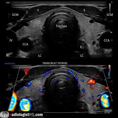 Longus Colli Ultrasound