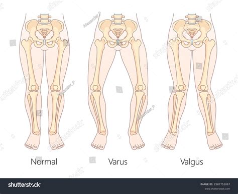 Image result for Leg Alignment