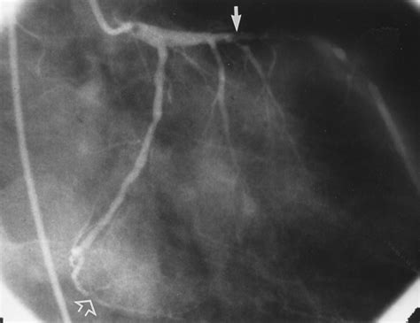 Causes of Transient Dilatation of the Left Ventricle During Myocardial Perfusion Imaging | AJR