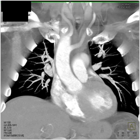 Right Sided Aortic Arch with Ductus Repair - Chest Radiology Case Studies - CTisus CT Scanning