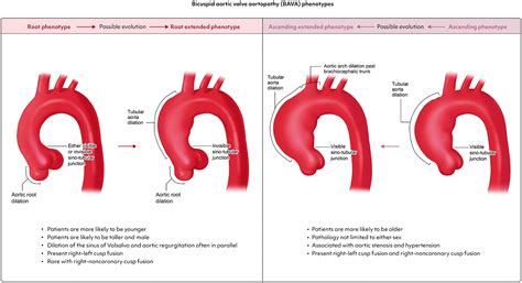 EACTS/STS Guidelines for Diagnosing and Treating Acute and Chronic Syndromes of the Aortic Organ ...