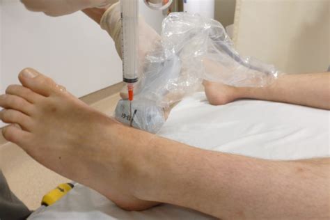 Image result for Ankle Injection Procedure