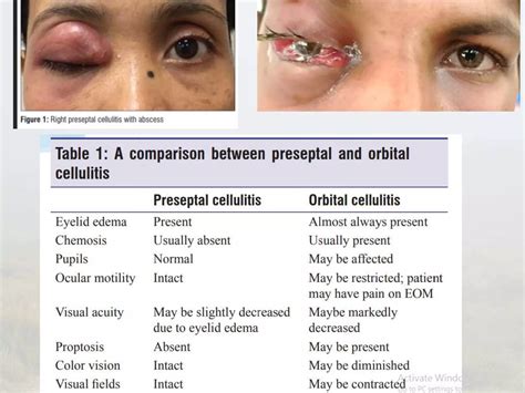 Orbital Cellulitis | PPTX