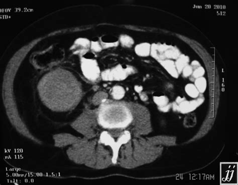 Kidney tumor, CT Scan – Radiopaedia