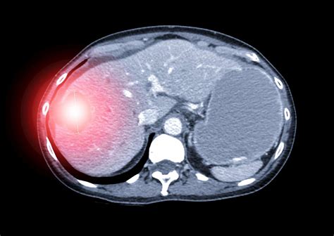 Liver Lesions: Types, Diagnosis, and Treatment