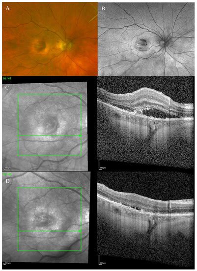 Bacillary Layer Detachment in Neovascular Age-Related Macular ...