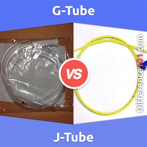 J-Tube vs. G-Tube: 5 Key Differences, Pros & Cons, Similarities ...