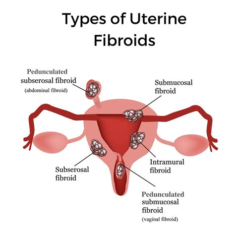 What Are Fibroids? - Urbanspice Nutrition