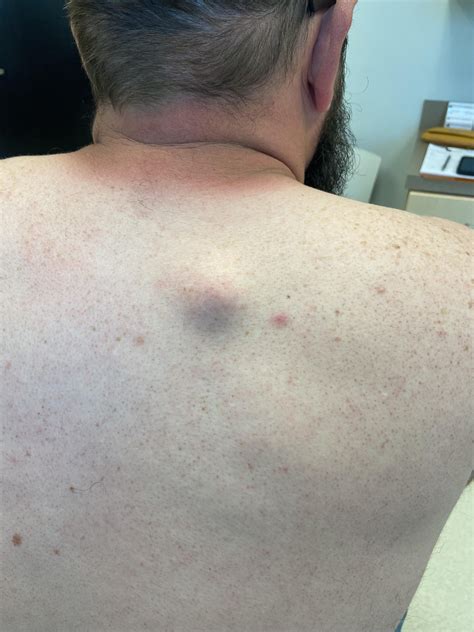 Sebaceous cyst removed from my husbands back yesterday : r/MedicalGore