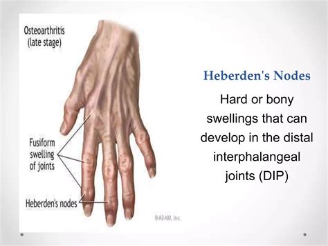 Osteoarthritis | PPTX