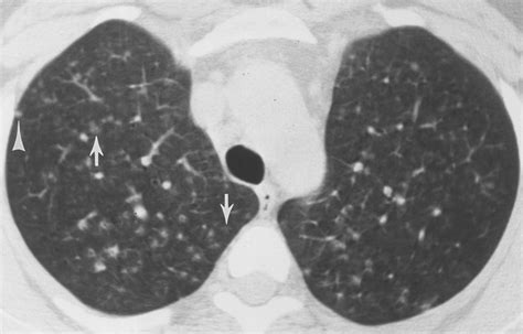 Hypersensitivity Pneumonitis | AJR