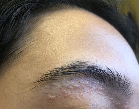 Bumps under my eyebrow, I noticed I get more after plucking my hairs ...
