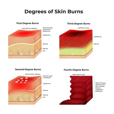 The Different Degrees Of Burn Wounds According To Skin Structure. – GPTEI